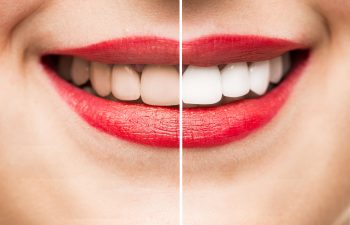 female smile before and after teeth whitening